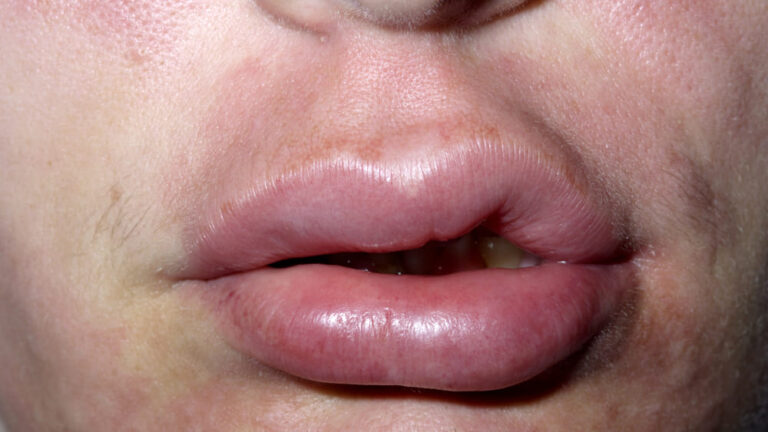 angioedemaereditario