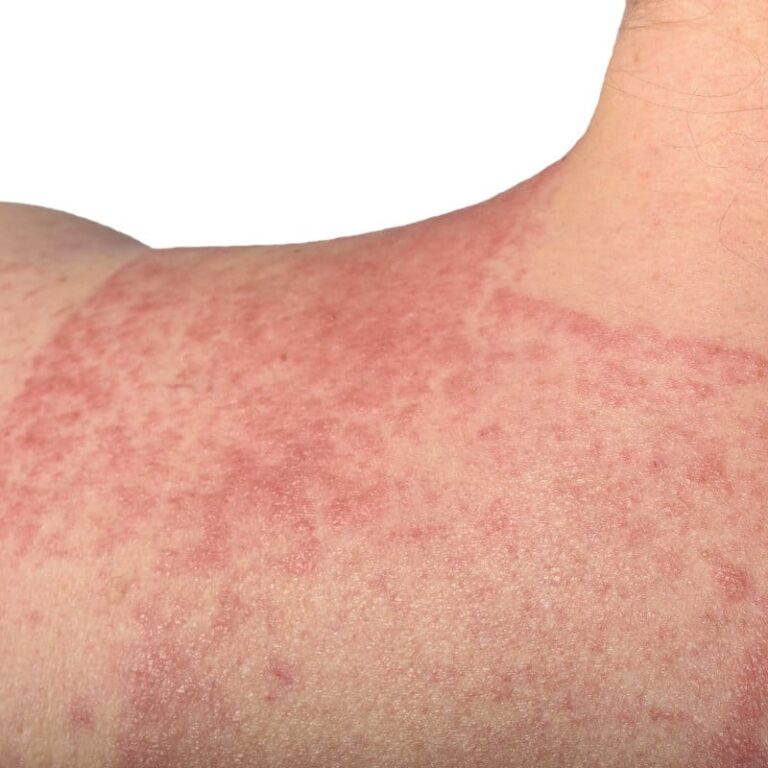 Pflasterallergie Rücken Nahaufnahme