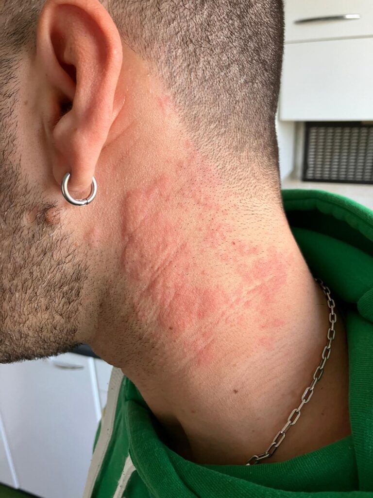 nettis-orticariacronica