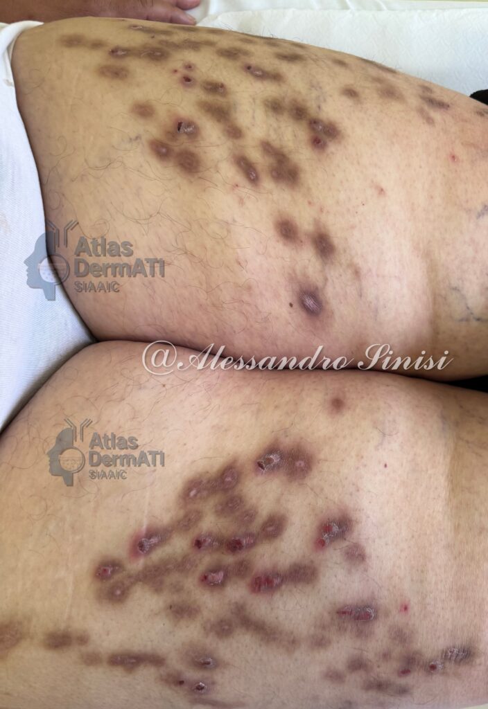 Dermatite atopica, prurigo nodularis