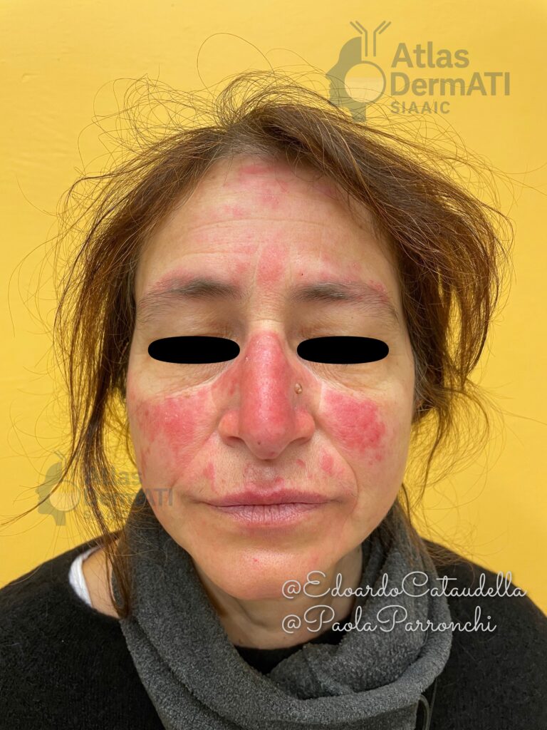 Malattie autoimmuni - ACLE