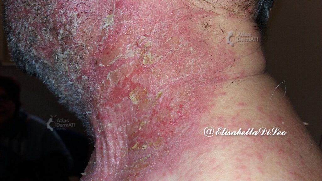 Derma allergica da contatto e DIC - DAC da profumi