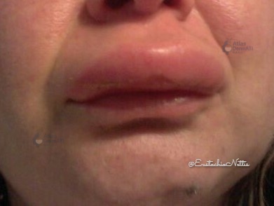 Cheilite granulomatosa