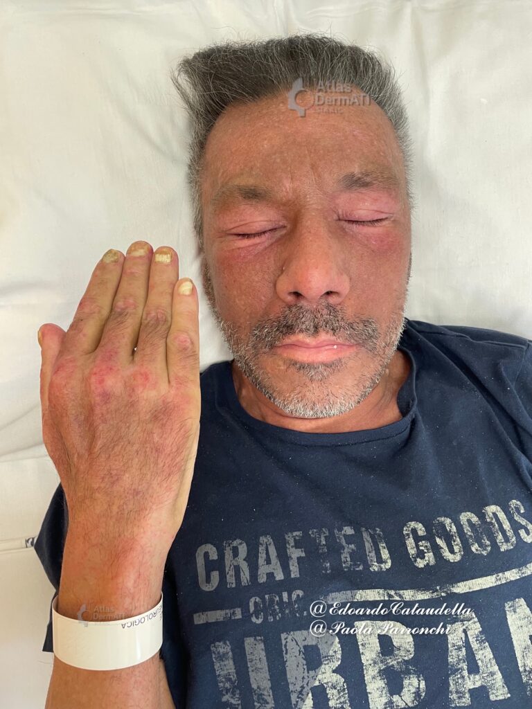 Rash eliotropo e gottron papules