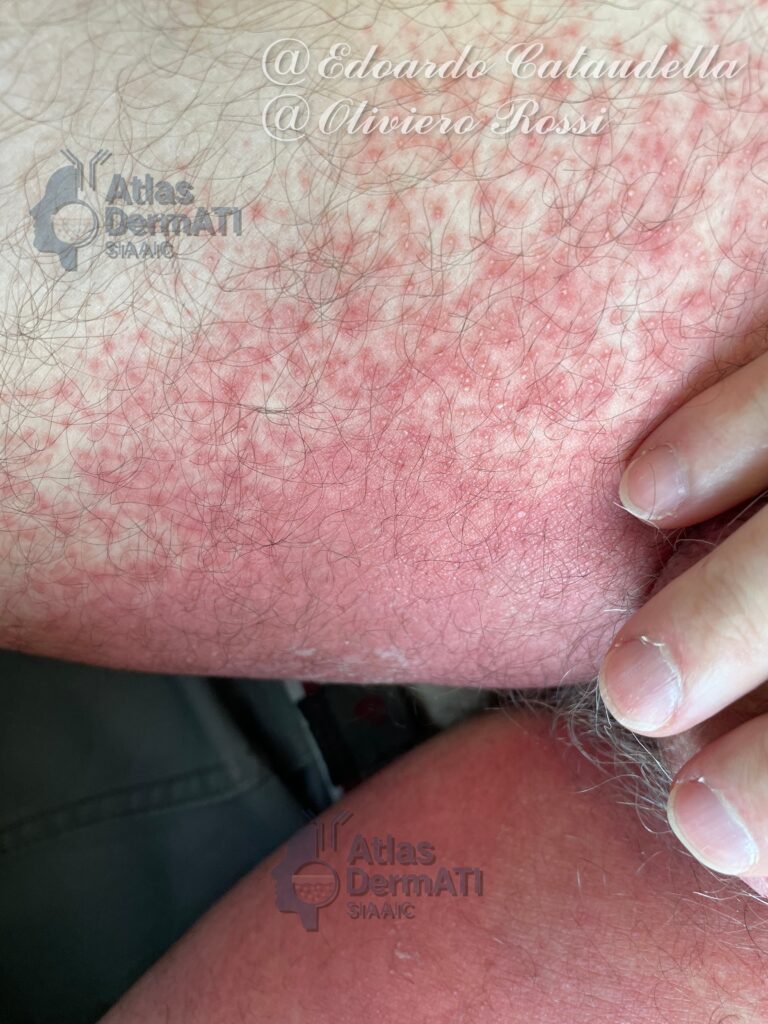 Reazioni avverse a farmaci - AGEP