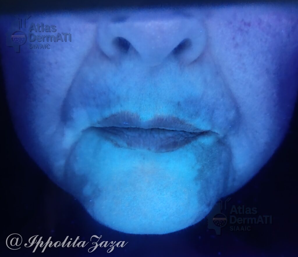 Vitiligine non segmentale