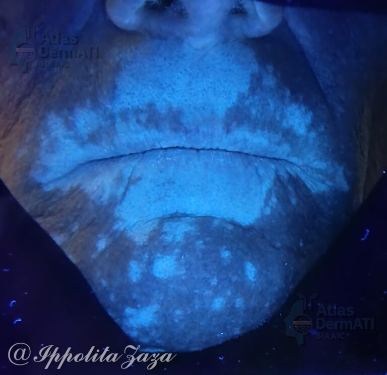 Vitiligine (caso 2) 01