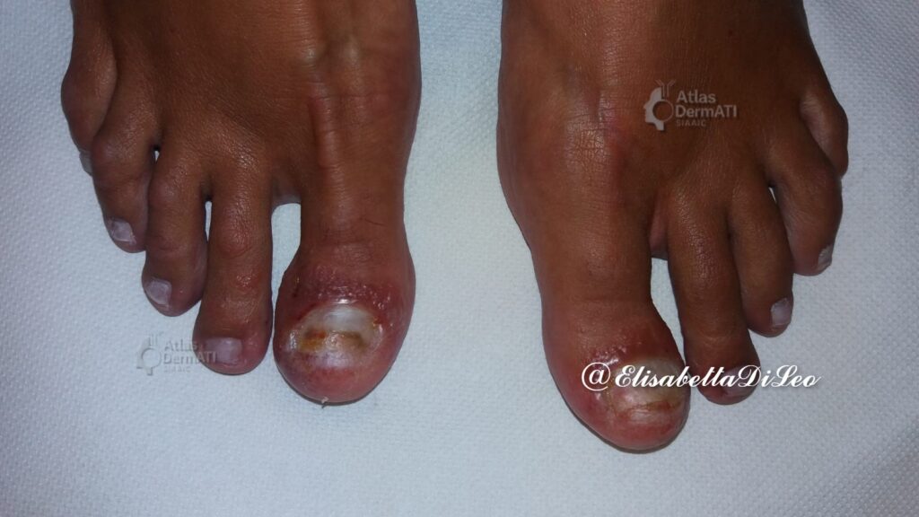 Dermatite allergica da contatto e DIC - DAC da metacrilati