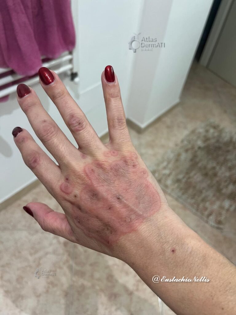 Reazioni avverse a farmaci eritema polimorfo