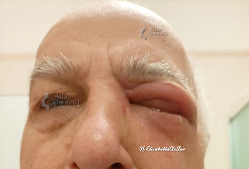 Reazione ritardata da collirio cloramfenicolo