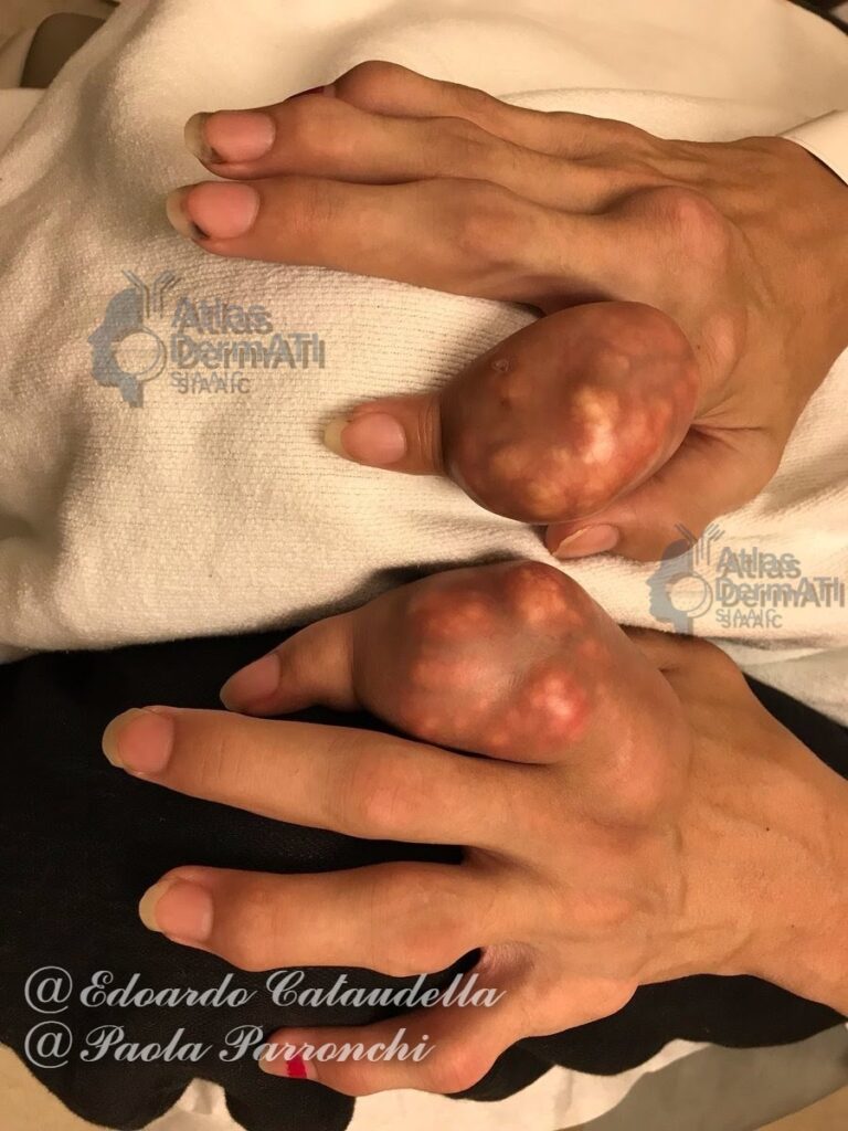 Artrite Gottosa Tofacea