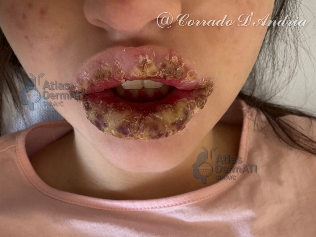 Cheilite da Isotretinoina