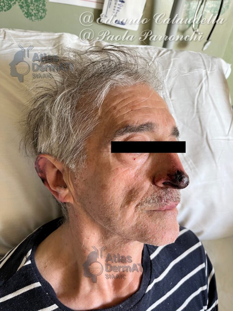 Crioglobulinemia Tipo I