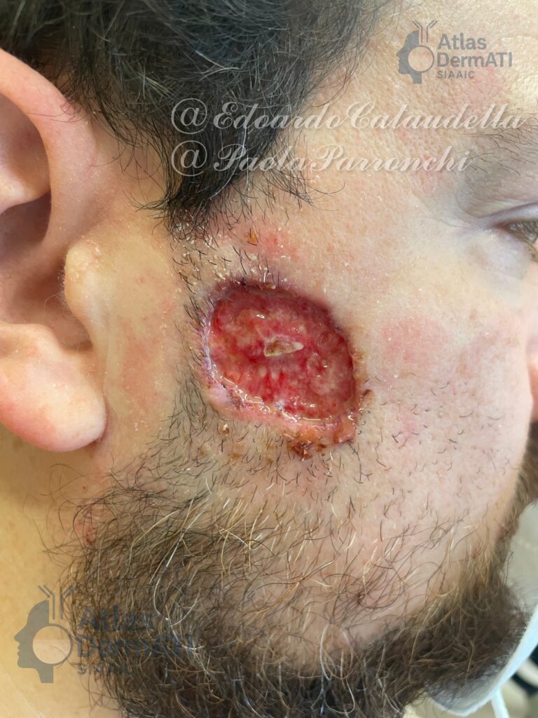Pioderma Gangrenoso