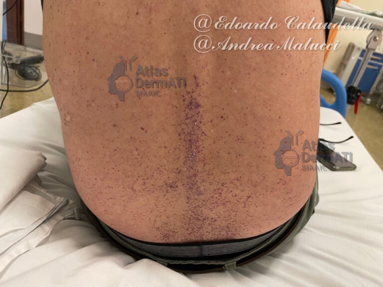 Angiocheratomi in malattia di Anderson-Fabry