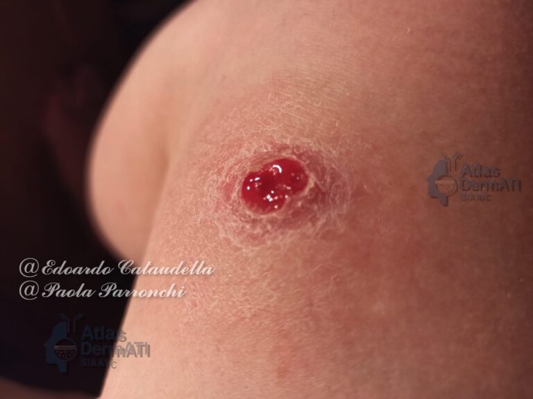 Leishmaniosi Cutanea