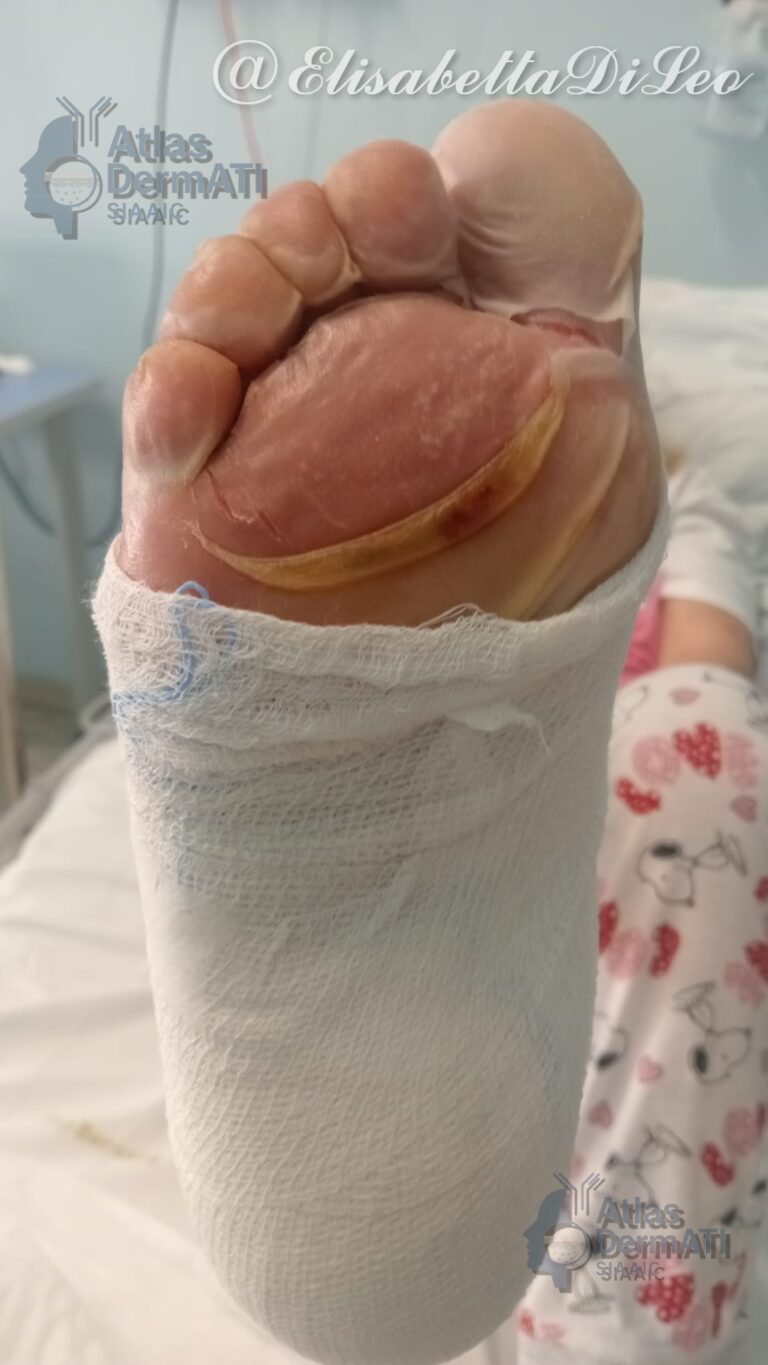 Sindrome di Stevens-Johnson