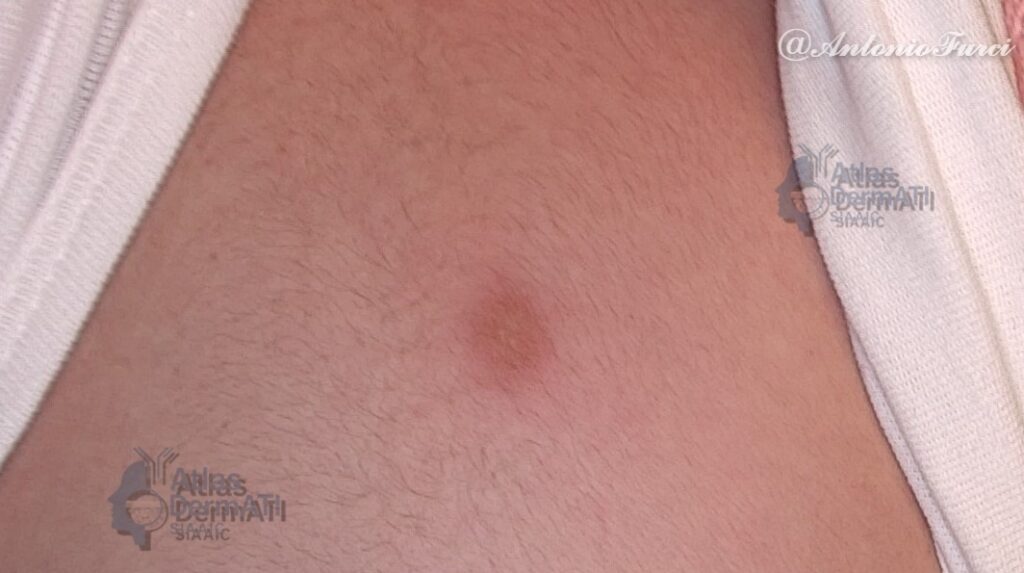 Mastocitoma cutaneo solitario