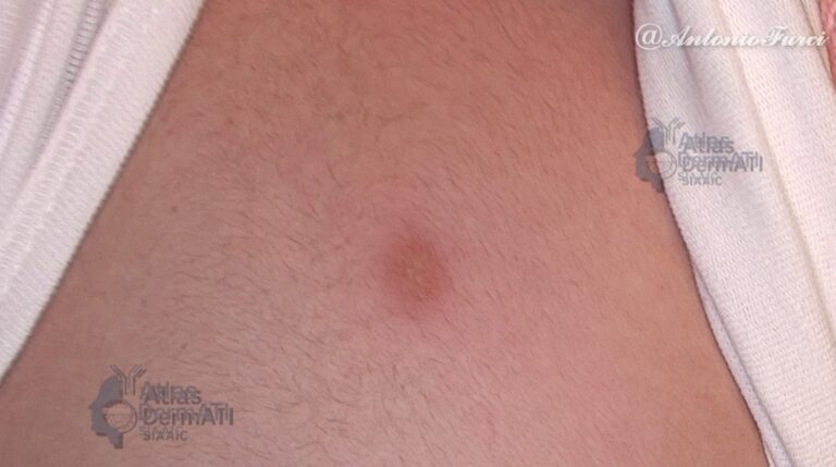 Mastocitoma cutaneo solitario