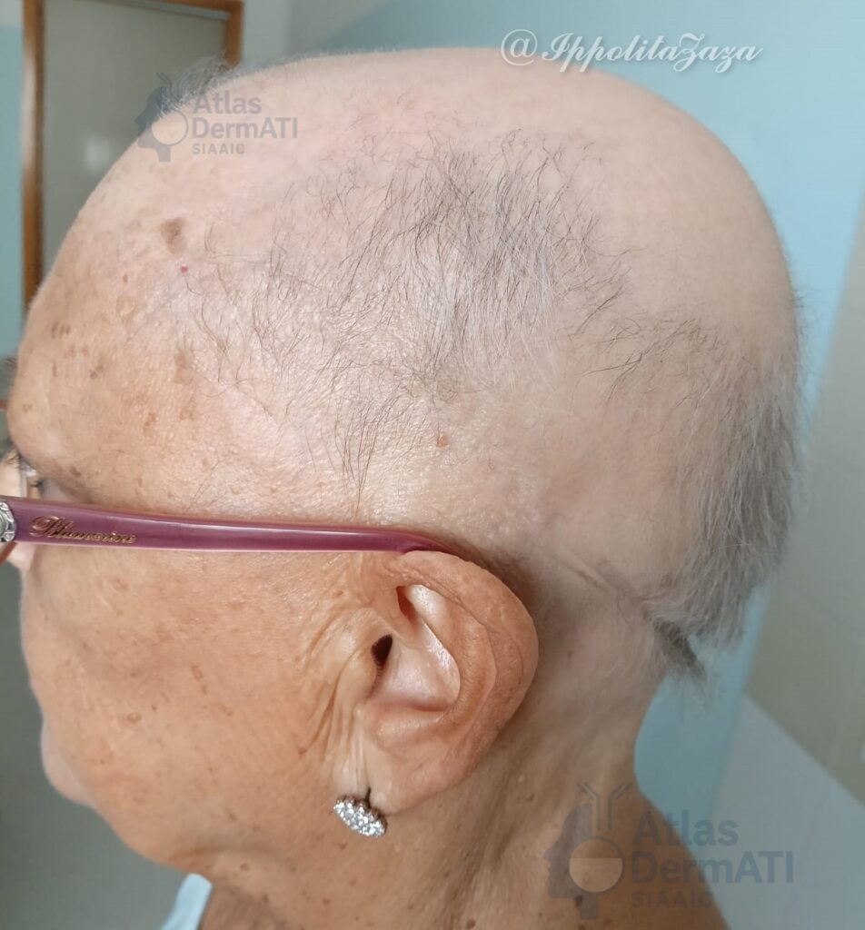 Alopecia Areata
