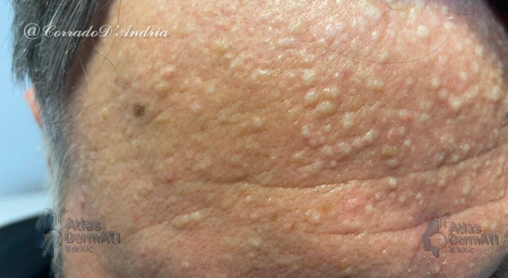 Adenoma sebaceo