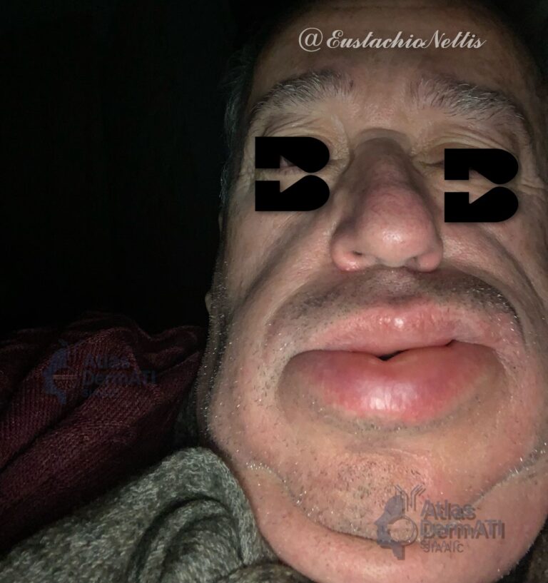 Angioedema da ACE inibitore