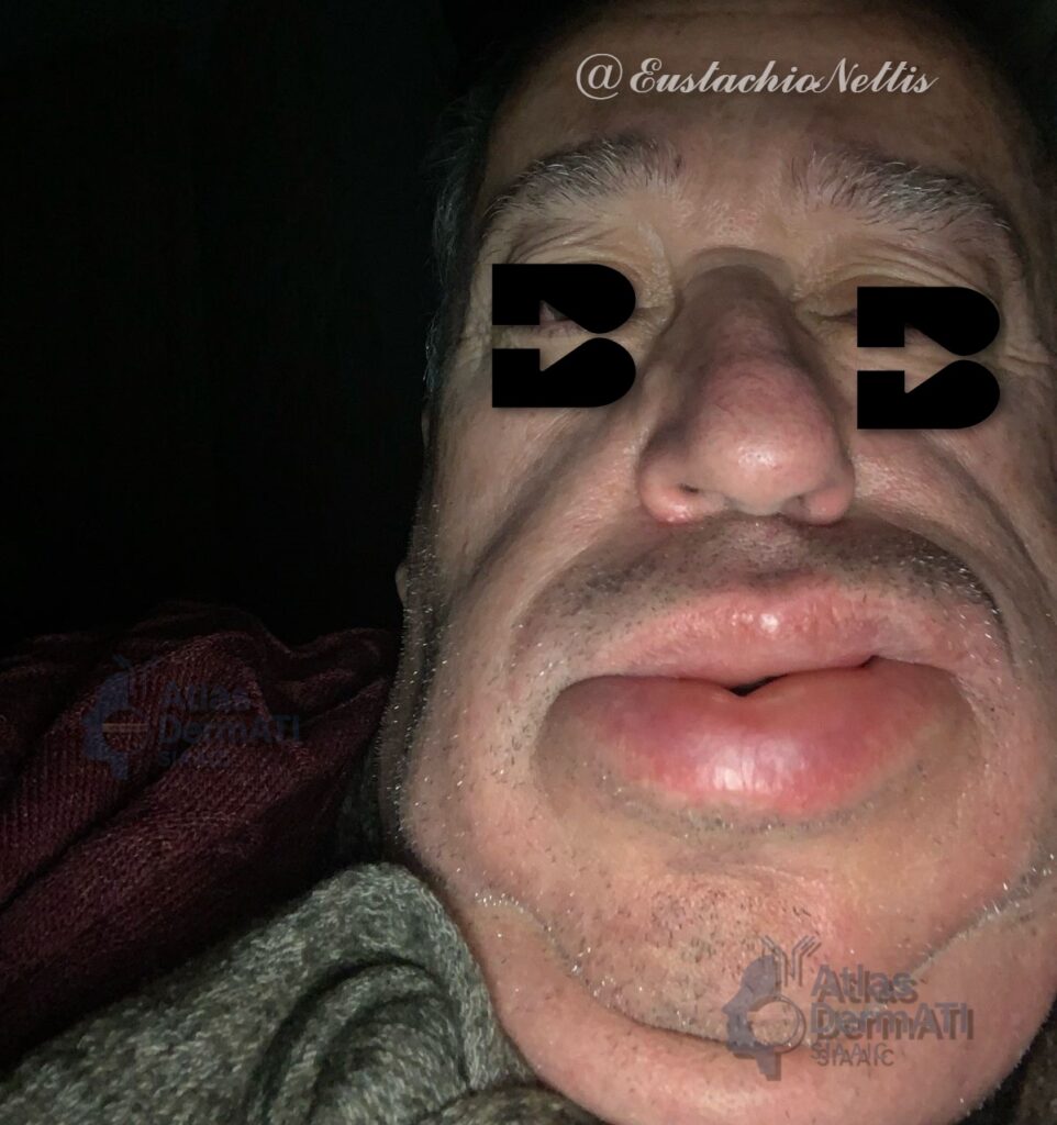 Angioedema da ACE inibitore