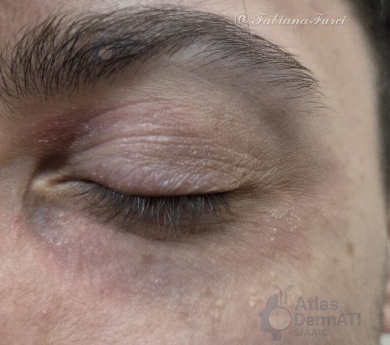 Dermatite allergica da contatto - Fabiana Furci - Foto 1