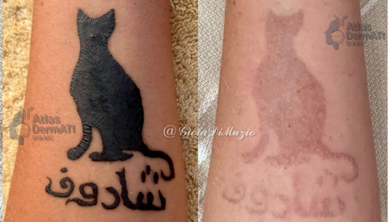 Dermatite allergica da contatto a tatuaggio temporaneo con Black Henna- gioia-di-muzio
