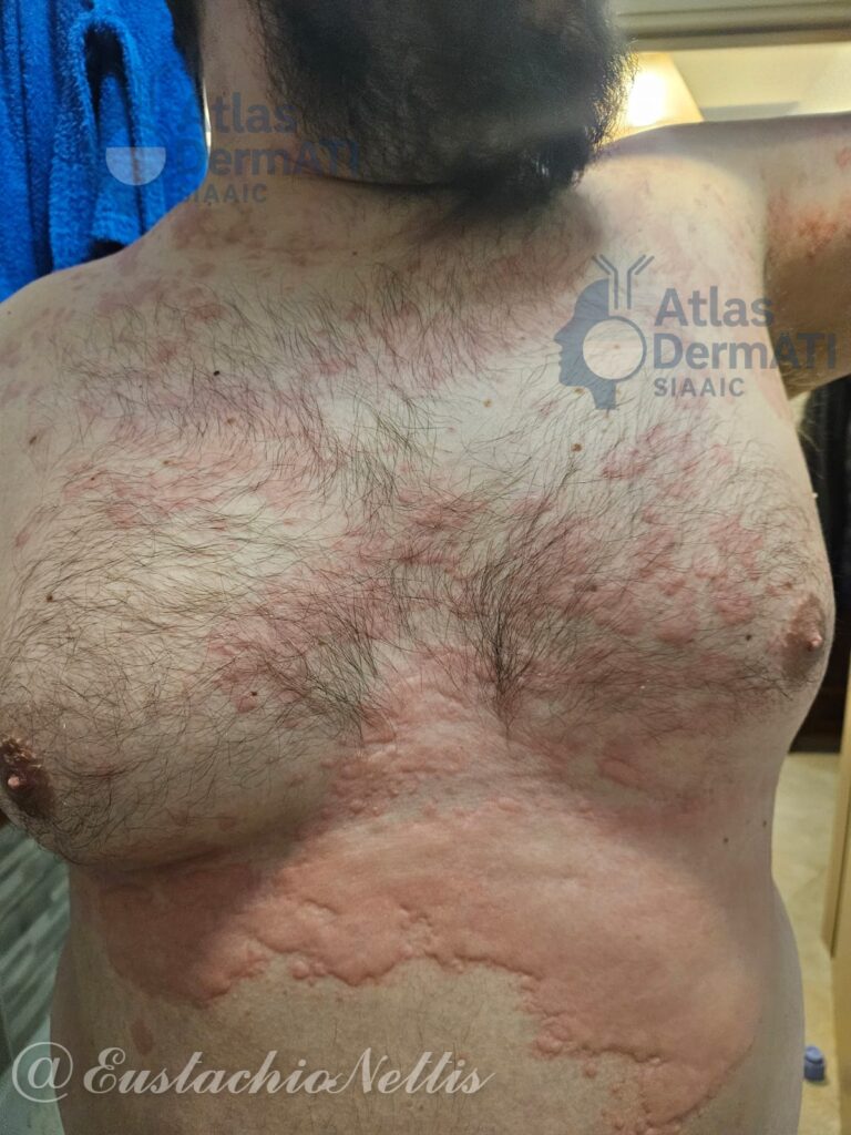 Orticaria acuta