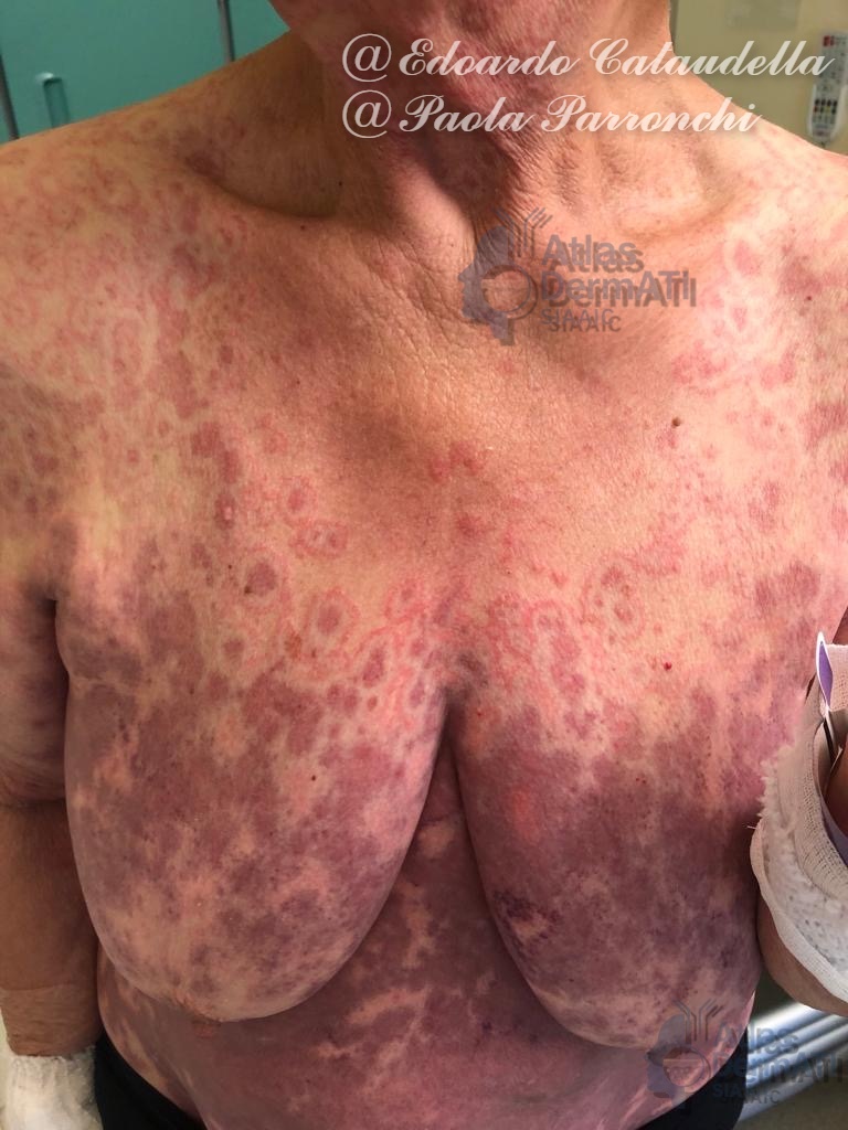 Sindrome di Steven Johnson - Necrolisi Epidermica Tossica