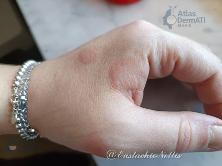 Lesioni elementari - Pomfi di Orticaria