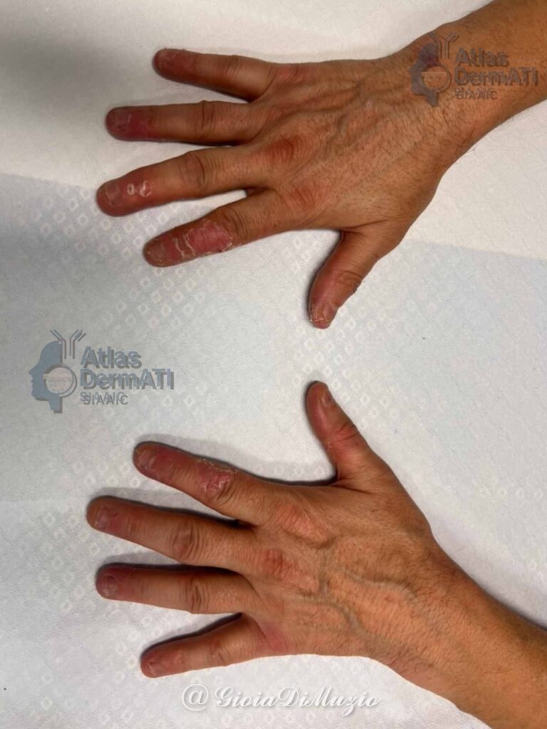 Eczema ipercheratosico