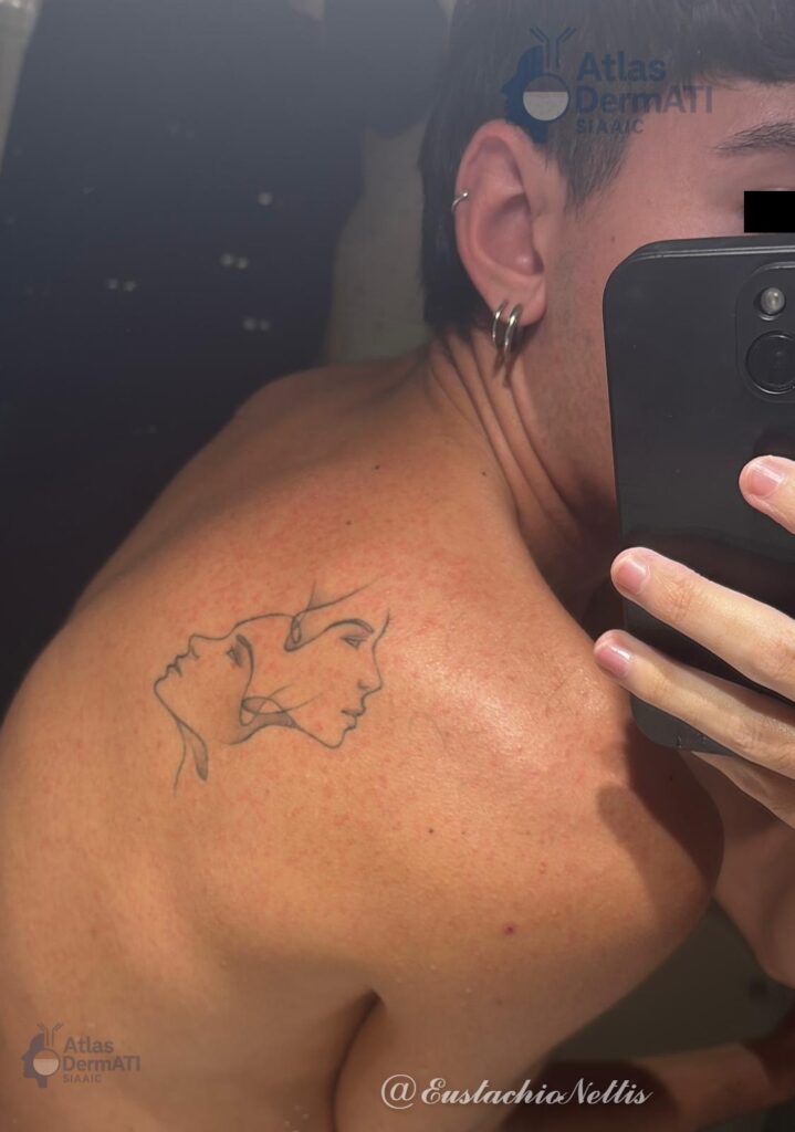 Orticaria colinergica