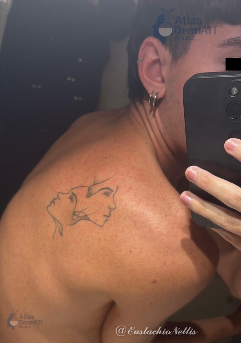 Orticaria colinergica