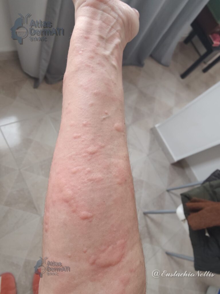 Orticaria cronica - Nettis - 01