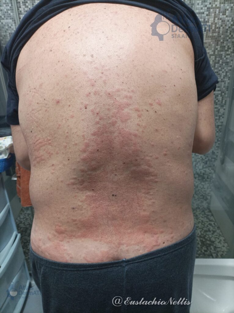 Orticaria cronica spontanea