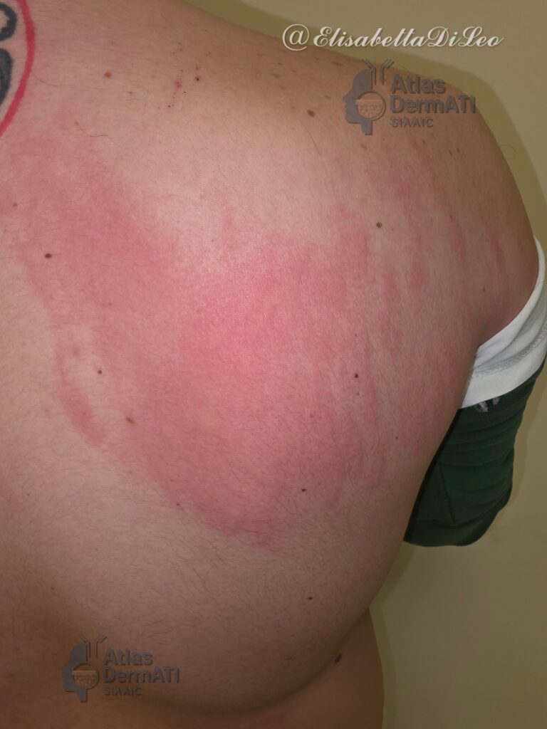 Orticaria dermografica - Foto 1 - Di Leo Elisabetta