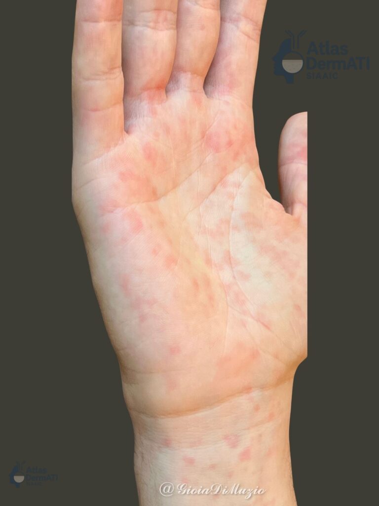 Rash maculo-papuloso in mononucleosi infettiva (Amoxicillina-correlato)