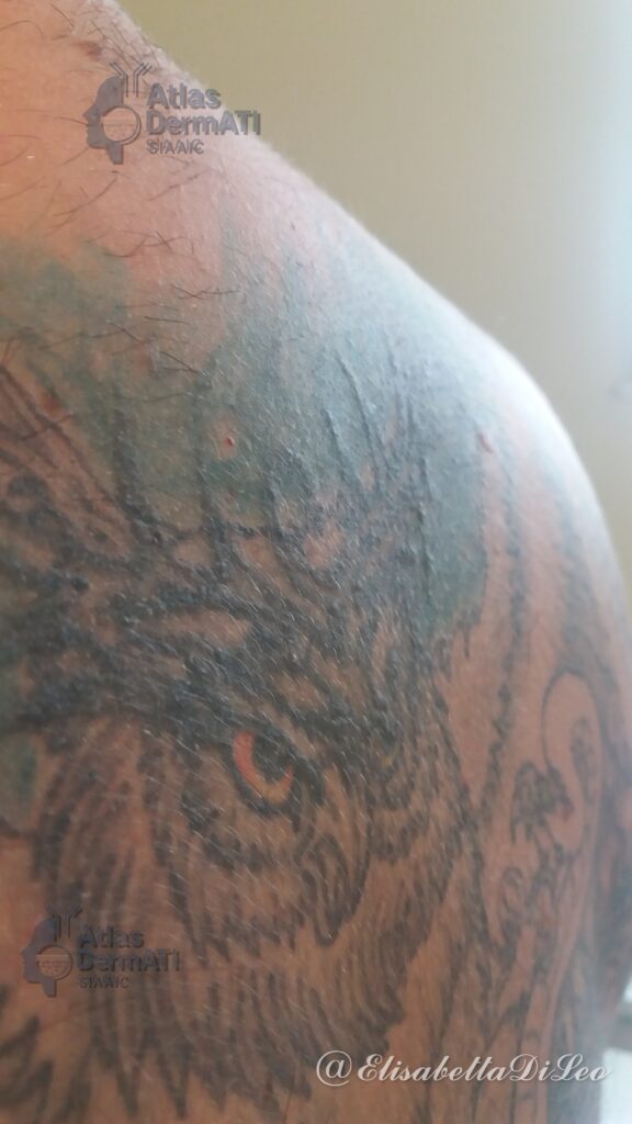 Reazione granulomatosa da tatuaggio