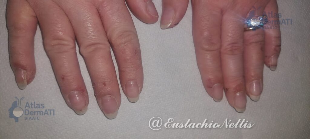 Dermatite allergica da contatto
