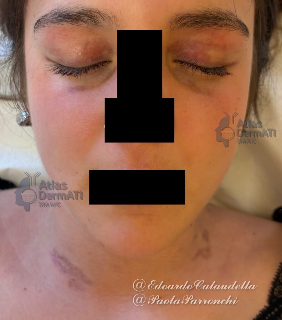 Lupus Cutaneo Subacuto Papulo Squamoso