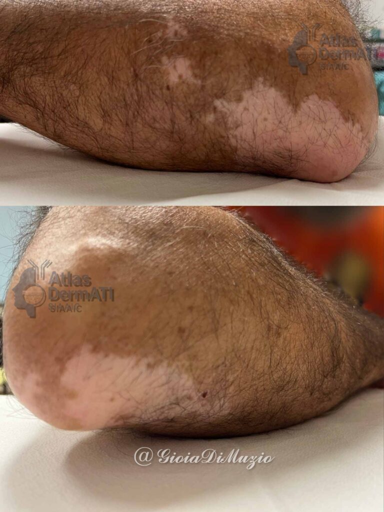 Vitiligine