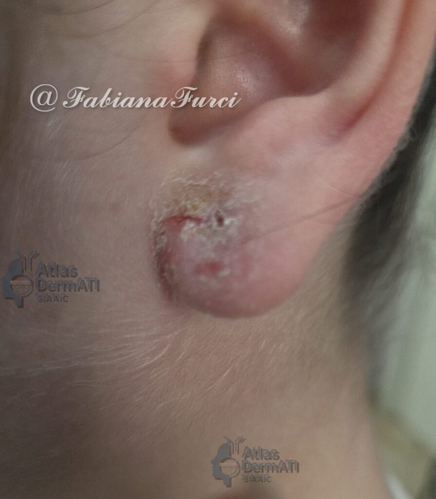 Dermatite allergica da contatto- Fabiana Furci