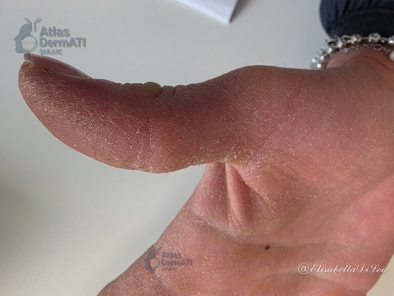 Dermatite irritativa da contatto delle mani - Di Leo - Foto 1