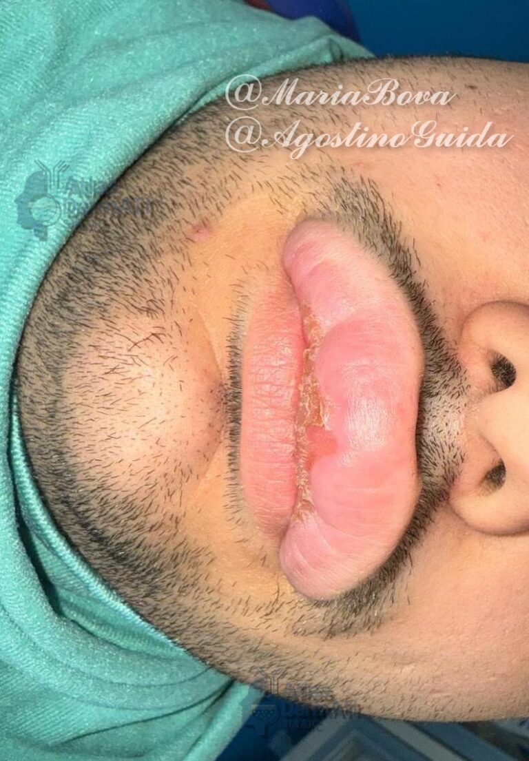 Granulomatosi oro faciale - Bova e Guida Foto 1
