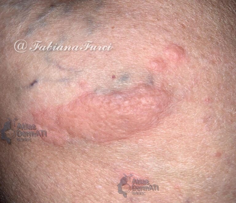 Orticaria- Furci fabiana