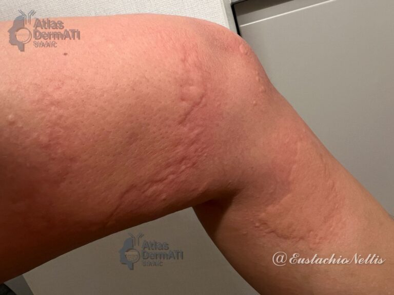 Orticaria acuta -Eustachio Nettis foto 1