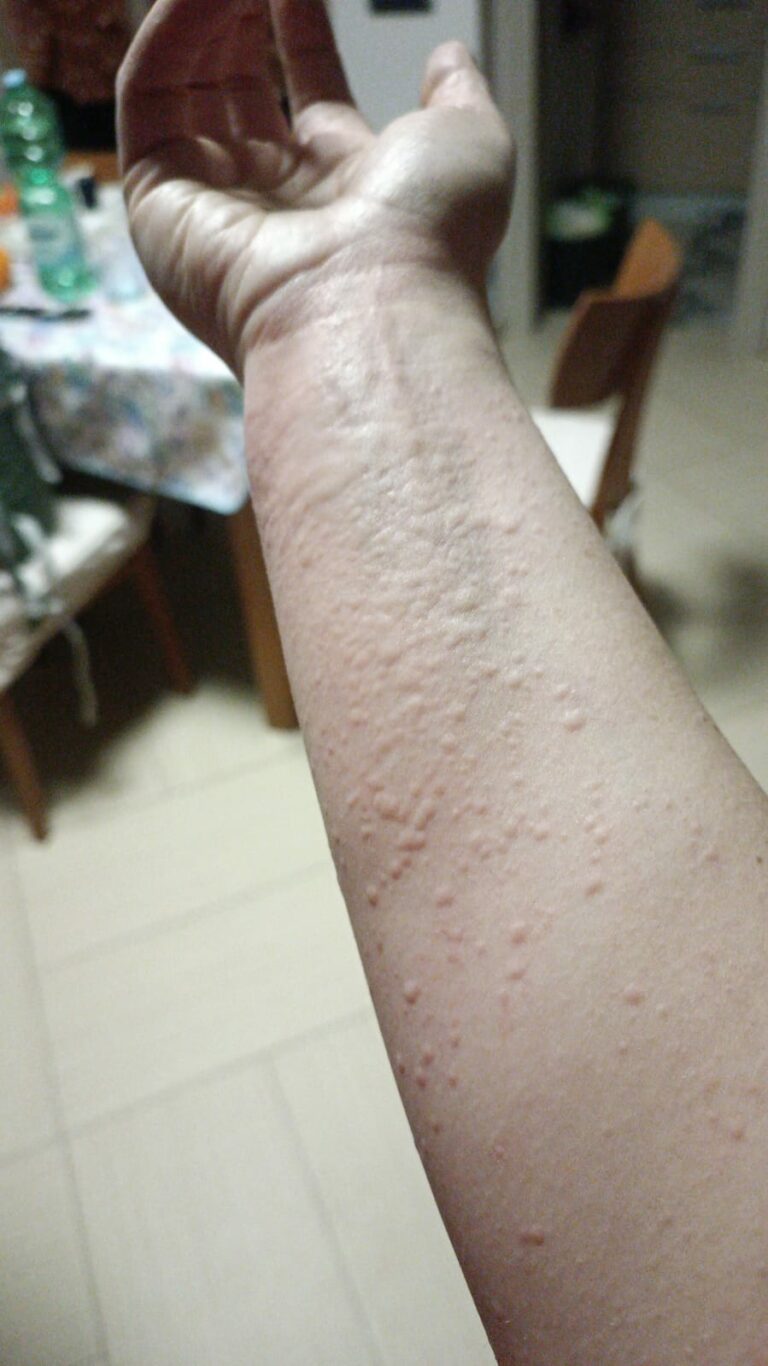 Orticaria colinergica- Eustachio Nettis 2
