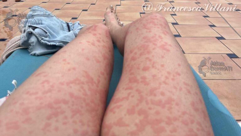 Orticaria cronica spontanea - Villani